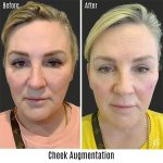 before and after chin augmentation front view female patient case 751