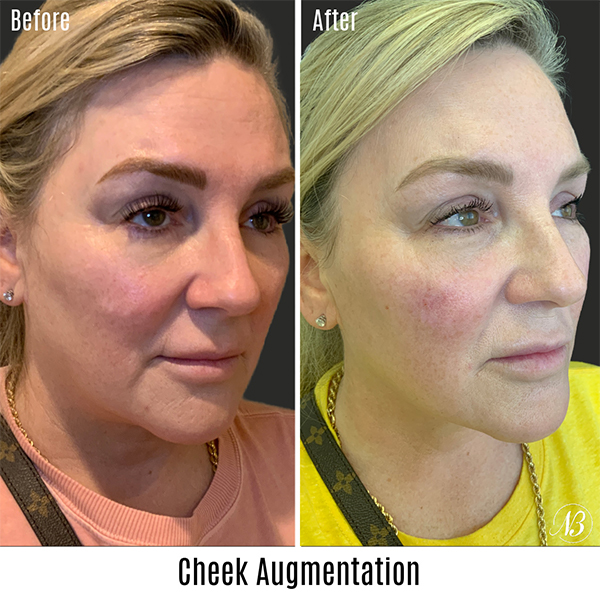 before and after chin augmentation right angle female patient case 751