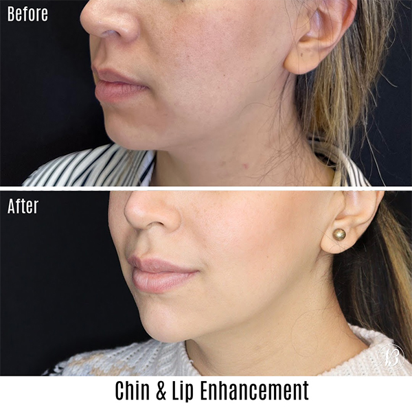 before and after lip augmentation left angle female patient case 755